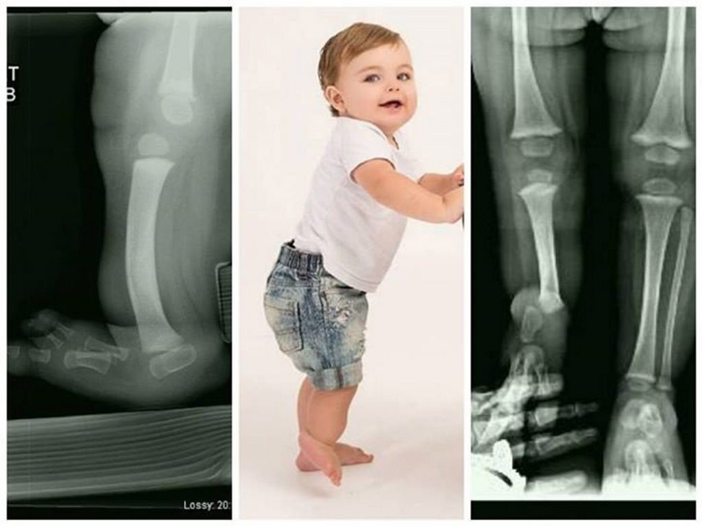 Khye’s right leg before the operation. Khye’s right leg before the operation.